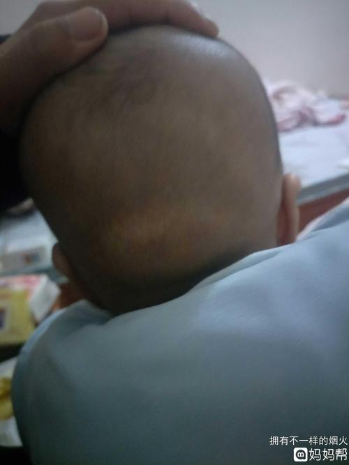 宝宝3个月了,后脑勺下方有一块鼓的？3个月大的宝宝会做什么检查