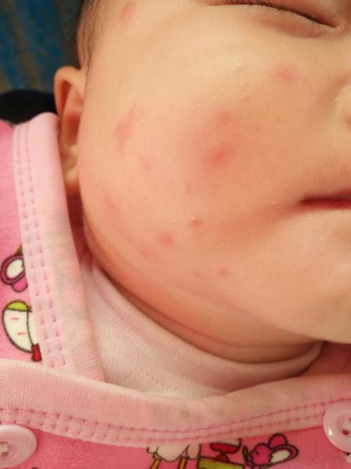 宝宝脸上长小红点像蚊子咬了的那种点是怎么回事？严重吗？(宝宝脸上小红点不像湿疹是什么)