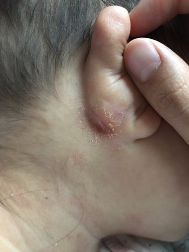 7个月的宝宝耳朵后面红肿需要怎么处理？(宝宝耳朵擦伤用什么药)