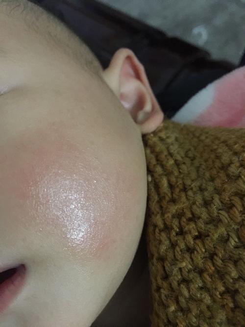 请问皮肤科医生，宝宝因为过敏脸上长了红疹，一般多久能好？(宝宝过敏时应注意什么好)