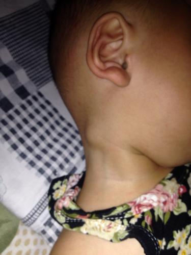 宝宝一岁九个月脖子里长了很多疙瘩怎么回事？宝宝为什么会长淋巴结