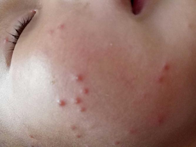 小孩水痘有哪些症状？宝宝长水痘什么症状