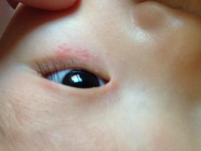 宝宝下眼睑发红是什么原因？宝宝眼睑红肿什么原因