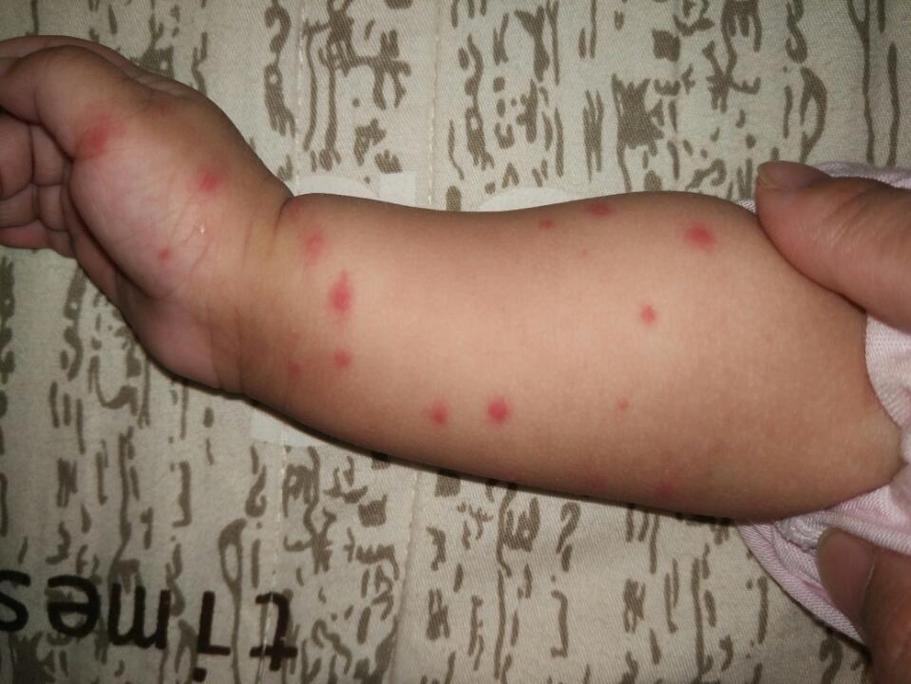 宝宝身上起红疙瘩像蚊子咬的那种怎么治疗？宝宝蚊子叮咬用什么
