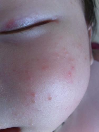 四岁宝宝脸上长痘痘是怎么回事？六岁宝宝脸上长痘痘是什么
