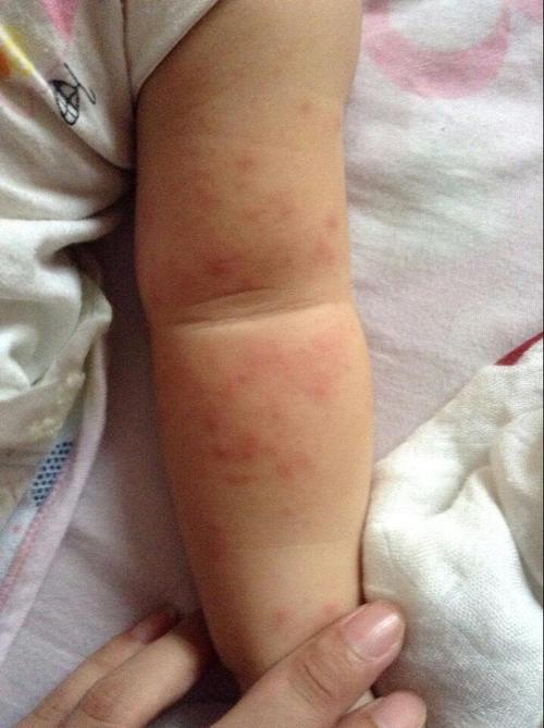 10个月的宝宝长中间红点周围一圈白的疹子是怎么回事？10个月宝宝长疹子是什么情况