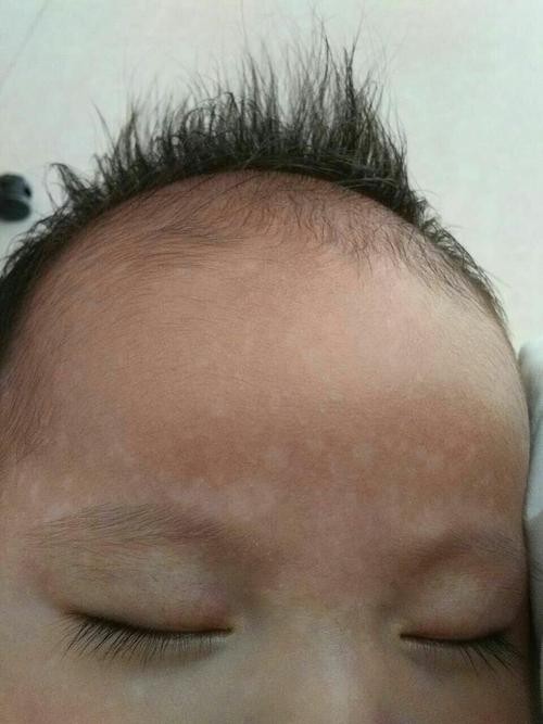 两个月的宝宝额头上有白点是什么？宝宝额头上白白的是什么