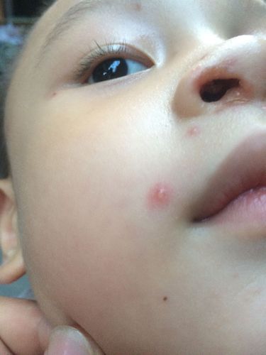 上午三岁宝宝的脸上起了很多红疙瘩，不会是水痘吧？宝宝脸上长水痘原因是什么引起的
