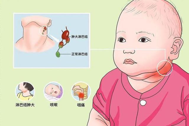 宝宝发烧有哪些症状？宝宝淋巴结有什么症状有哪些症状图片大全