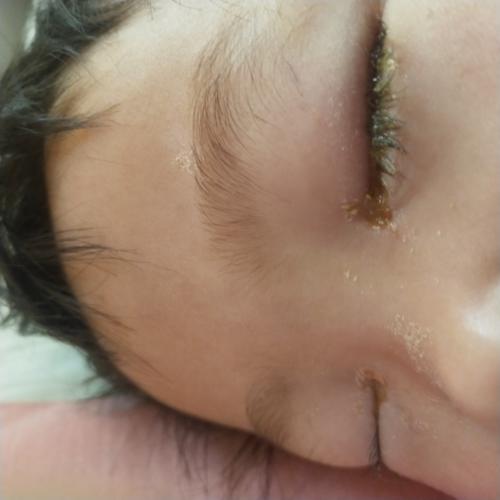 宝宝感冒了，眼睛有眼屎黄浓状的？宝宝脓性眼屎什么原因引起的