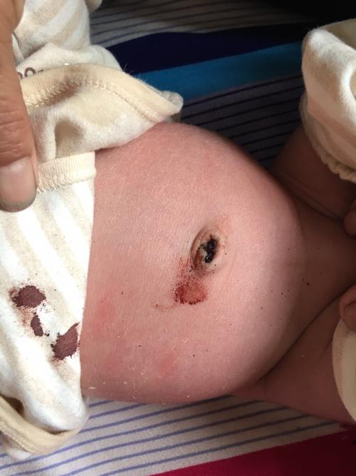 月子里宝宝肚脐出血是什么原因？宝宝脐带为什么出血