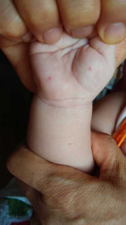手腕上长小红点，这是什么原因引起的？宝宝手腕上长了个红点是什么原因