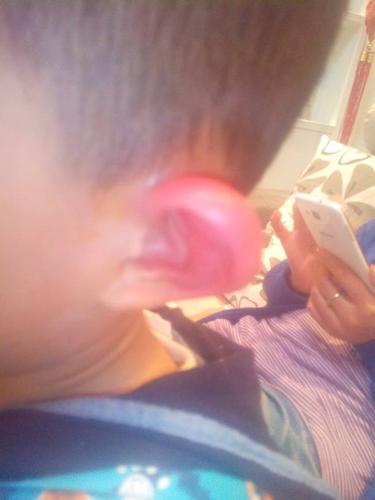 1岁耳朵突然肿了？宝宝耳朵肿胀是什么原因引起的