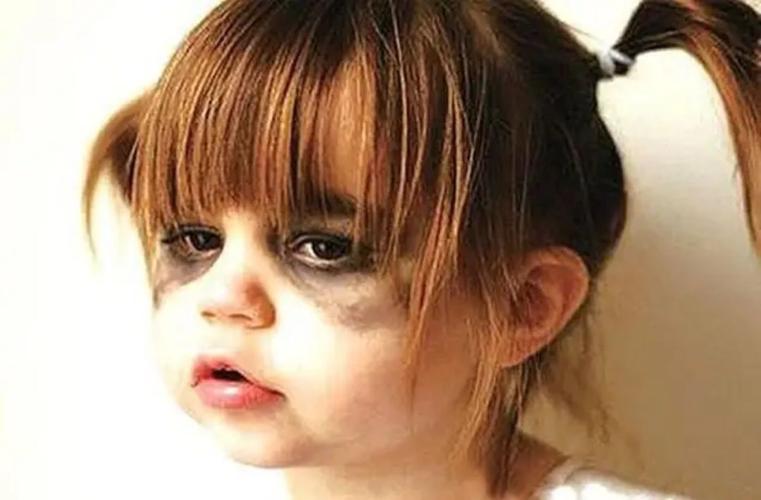 女儿8岁眼睛都有黑眼圈怎么回事？宝宝有黑眼圈是缺什么