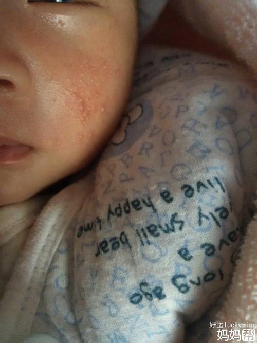 满月孩子脸上湿疹，该怎么办呢？满月宝宝为什么长湿疹怎么办
