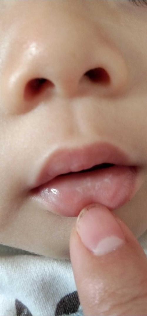 婴儿嘴巴里的白色是什么？宝宝嘴巴里面有白色的点是什么