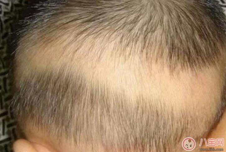 三周岁宝宝头上有一根白头发怎么回事？一岁宝宝掉头发缺什么原因引起的吗