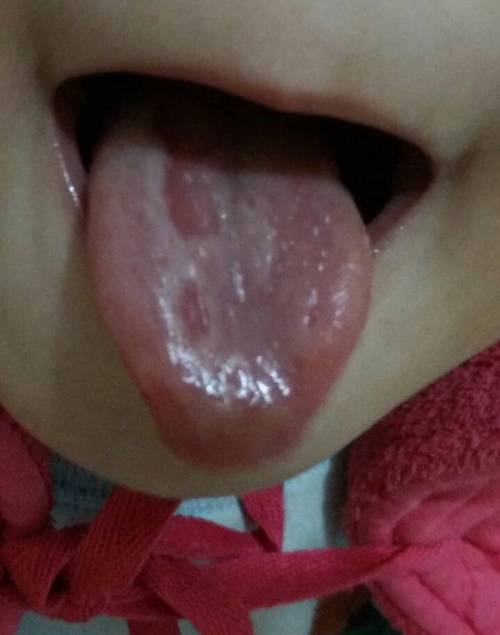 1岁婴儿舌头上有白苔是怎么回事？1岁内宝宝要做什么检查