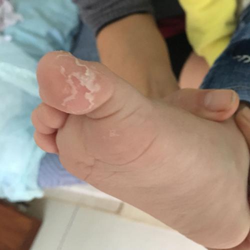 小脚趾开裂脱皮不痒怎么回事？2岁宝宝脚趾头全脚脱皮是什么原因引起的