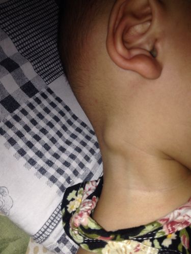 孩子脖子两侧有能摸到的淋巴结。孩子不疼。正常吗？宝宝脖子两侧肿大是什么原因
