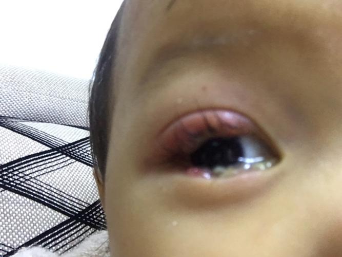 两岁宝宝眼睛痒是怎么了？（两岁宝宝做眼睛检查什么原因引起的）