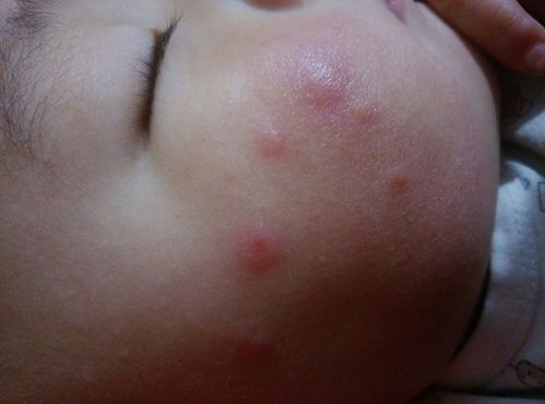 三个月的宝宝脸上长了几颗红痘痘，很大？（宝宝脸上长了好多红痘痘是什么）