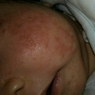 宝宝脸上湿疹的最佳治疗方法？（宝宝满脸湿疹什么原因造成的）