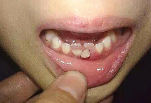 儿童长大牙很痛怎么办？我能给孩子吃什么缓解疼痛？（六个月的宝宝长牙齿需要注意什么）