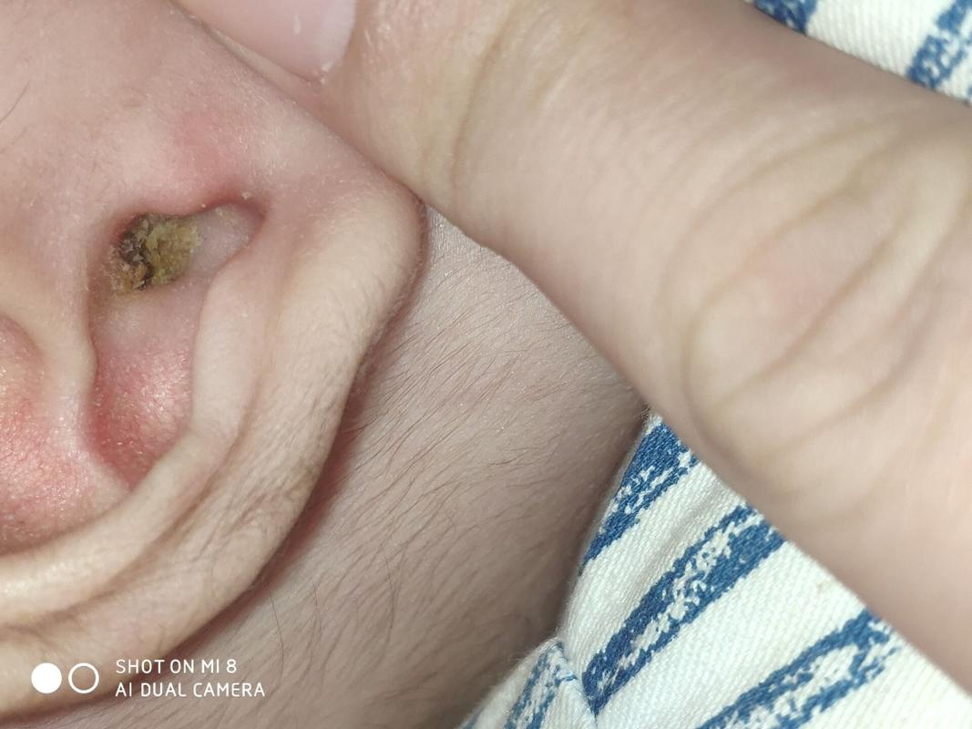 1岁半宝宝耳朵里有耳屎似的硬东西？（一岁半宝宝正常耳朵内是什么样子的）