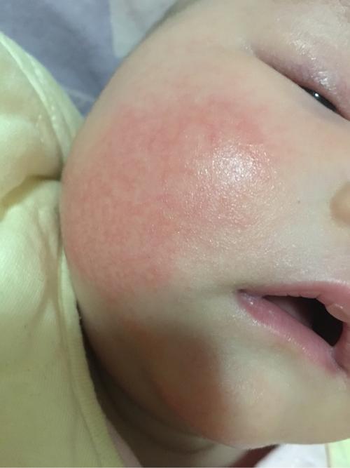 一个月宝宝脸上有红血丝怎么办？（宝宝脸为什么有红血丝）