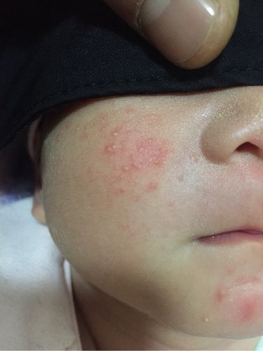 三个月大的宝宝脸上起了湿疹怎么办呢？（宝宝三岁了脸上为什么突然起湿疹怎么办啊）