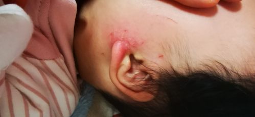 宝宝5个月，耳朵后面有点烂了，可以抹红霉素软膏吗？（宝宝嘴巴长溃疡要用什么药膏）
