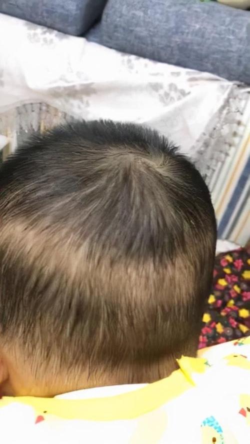 我小孩今年1岁半了，怎么头发特别稀少，特别是头顶上面，怎么办？（一岁宝宝头发少缺什么原因）